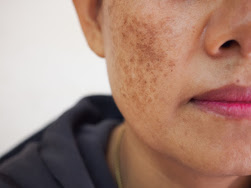 How To Remove Pigmentation Naturally At Home