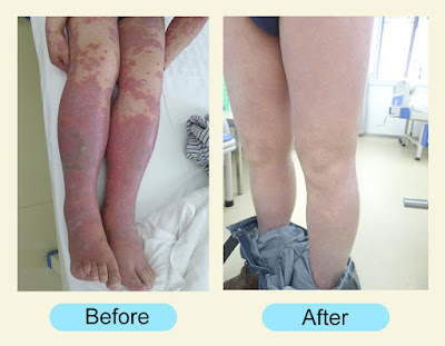Psoriasis Pictures