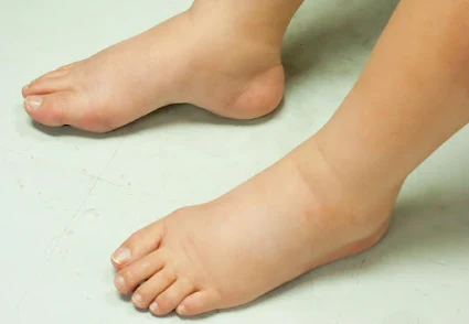 Reasons Why Your Feet are Swollen