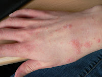 Scabies Treatment