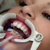Tác hại của việc niềng răng sai cách là gì?