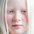 ALBINOs & THE TROUBLES THEY FACE....