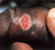 Sipilis di penis Sipilis di penis