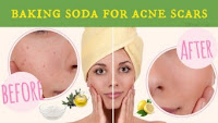 Baking Soda for acne