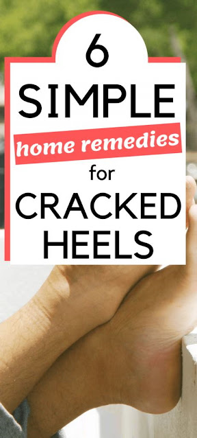 6 Simple Home Remedies For Dry, Cracked Heels