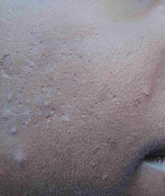 remove pimples home remedies