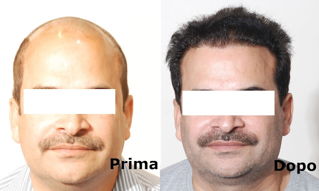 Paziente di 48 anni, prima e dopo il trapianto di capelli con metodo FUE Zaffiro in Albania, Tirana