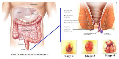 Jual Obat Ambeien De Nature Di Jakarta Barat