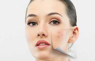 How to Eliminate Acne and scars naturally