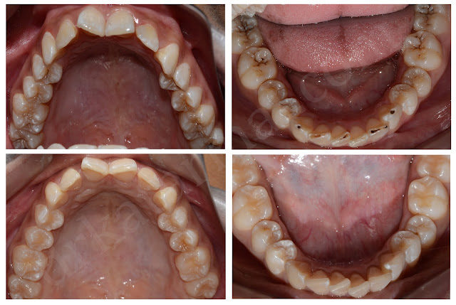Dental Decay involving multiple teeth and after fillings