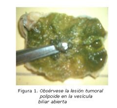 tumor vesícula
