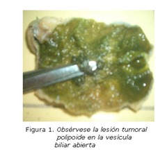 tumor vesícula