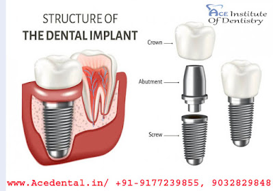 Dental implant courses in India