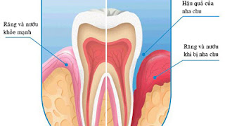 bệnh nha chu là gì