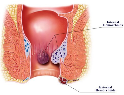 pengobatan hemoroid 