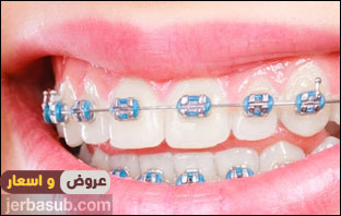 افضل دكتور تقويم اسنان في الرياض