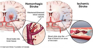 Ilmu mengobati stroke, Pengobatan Stroke Pendarahan Otak, Obat Generik Untuk Stroke Ringan, Tips Mengobati Stroke, Obat Stroke Daun Sirsak, Obat Apotik Untuk Stroke, Obat Alami Untuk Penyakit Stroke Ringan, Obat Stroke Infark, Epidemiologi Penyakit Stroke Hemoragik, Obat Ampuh Stroke Ringan, Obat Stroke Cara Islam