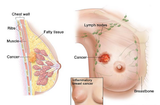 penyebab timbulnya kanker payudara