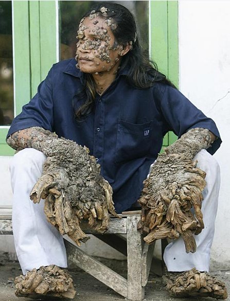 'Tree Man of Java' Dede