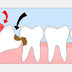 Khi nào nên nhổ răng khôn?