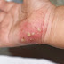 5 Effective Home Remedies for Scabies Relief