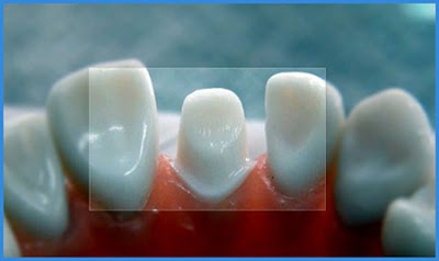 Các loại cầu răng sứ phổ biến