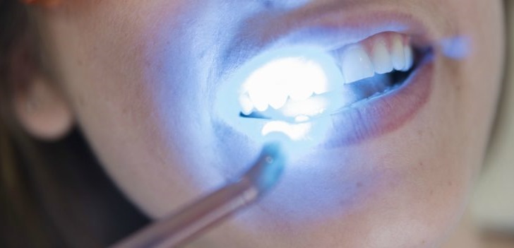 You Shouldn’t Get Your Teeth Whitened if You Fall into These 9 Categories