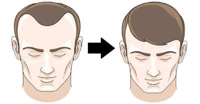 Reverse Balding Home Remedies Step-By-Step