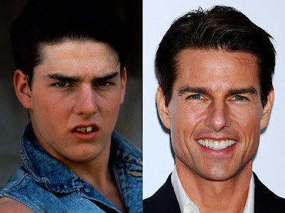Celebrities before and after a dentist visit. Tom Cruise Zac Efron