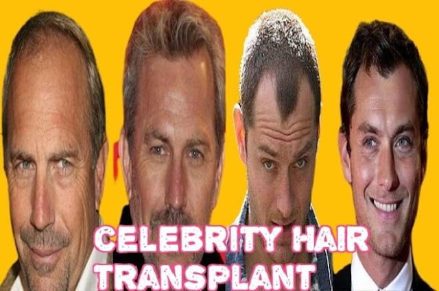 What celebrities have had a hair transplant Secrets You Never Knew.