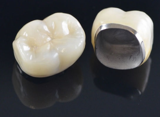 Corone dentali in metallo ceramica