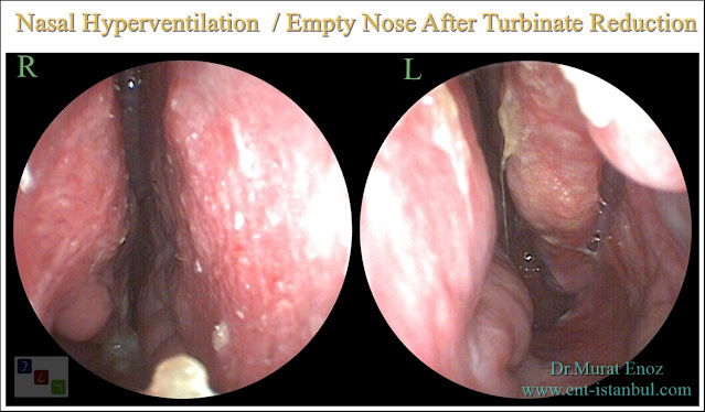 Nasal Hyperventilation,Empty Nose Syndrome,dry nose,Thick nasal secretion,