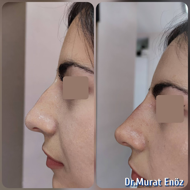 Cost of non-surgical rhinoplasty in Istanbul,Nose filler injection cost in Turkey,Cost of non-surgical nose job in Istanbul,Cost of non surgical nose job with filler in Istanbul,