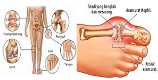 Mengatasi Asam Urat Pada Lansia, Asam Urat Dan Pantangan Makanan, Aplikasi Cek Asam Urat Di Android, Asam Urat Dan Rematik Perbedaan, Obat Alami Asam Urat Kaskus, Asam Urat Gejala Dan Penyebab, Ramuan Obat Untuk Penyakit Asam Urat, Ciri Ciri Asam Urat Pada Punggung, Obat Herbal Asam Urat Dan Sakit Pinggang, Nilai Normal Asam Urat Kolesterol Dan Gula, Asam Urat Di Jempol Kaki, Cara Mengobati Asam Urat Tinggi Secara Alami, Normal Asam Urat Bagi Pria Dan Wanita, Asam Urat Normal Pada Ibu Hamil, Hasil Normal Asam Urat Dan Kolesterol, Obat Pencegah Penyakit Asam Urat, Penyakit Asam Urat Dan Obat Nya, Cara Mengobati Sakit Asam Urat Tradisional, Mengatasi Asam Urat Di Kaki, Obat Asam Urat Dalam Darah, Www.Obat Alami Asam Urat, Asam Urat Kolesterol, Buah Sirsak Untuk Obat Asam Urat, Bengkak Asam Urat Tidak Sembuh, Cara Cepat Menurunkan Asam Urat Secara Alami, Buah Pepaya Untuk Obat Asam Urat, Nilai Normal Glukosa Asam Urat Dan Kolesterol, Cara Mengobati Asam Urat Dengan Minyak Tanah, Asam Urat Apakah Penyakit Keturunan, Harga Obat Asam Urat Super 