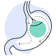 https://www.coherentmarketinsights.com/industry-reports/intragastric-balloon-market