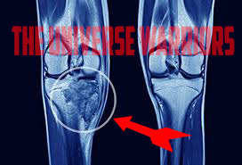 What is Bone cancer