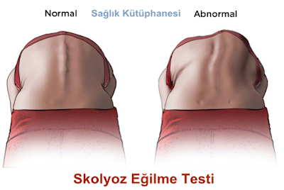 Skolyoz hastalığı Eğilme Testi