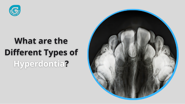 What are the Different Types of Hyperdontia?