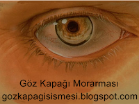 Göz Kapağı Morarmasının Nedenleri Ve Tedavisi