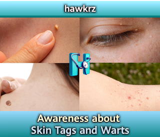Skin Tags and Warts