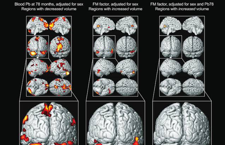 Lead Exposure During Childhood Is Linked To Brain Deficits In Middle-Age, According To Study