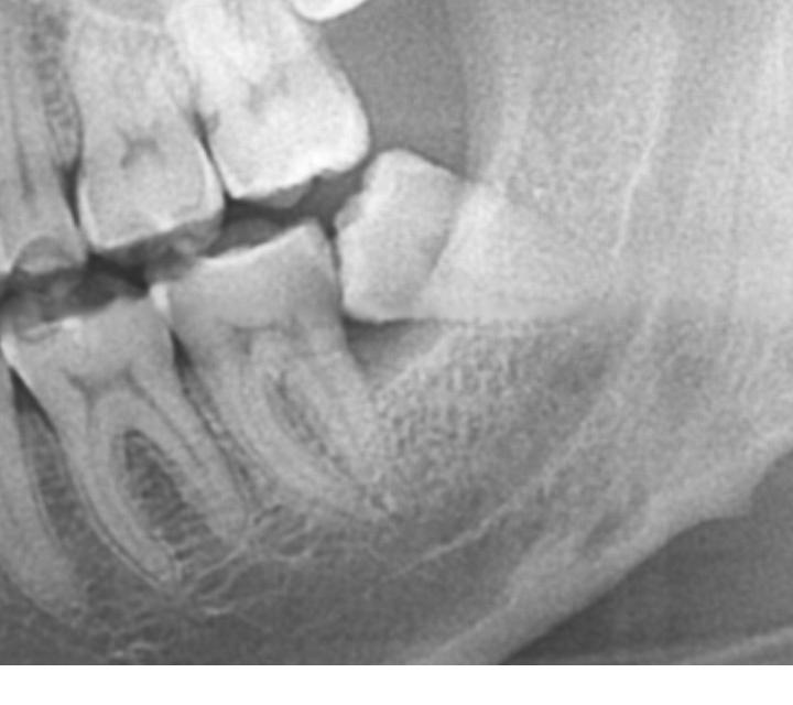 Impacted third molar causing