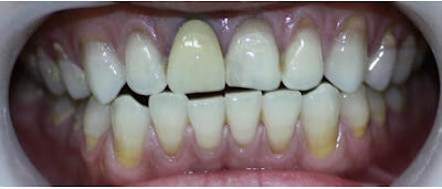 3 nguyên nhân khiến răng sứ bị đen viền nướu-1