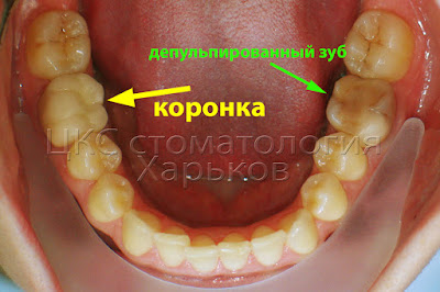 Зуб с коронкой и депульпированный зуб