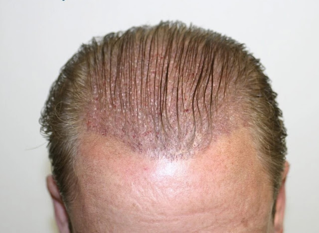 50enne esposto al sole un giorno dopo aver fatto il trapianto di capelli con il metodo DHI