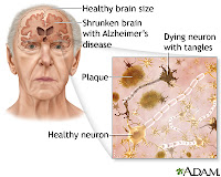 obat herbal tradisional alami penyakit alzheimer