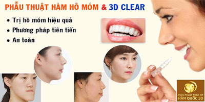 Phẫu thuật hàm hô móm và 3D clear