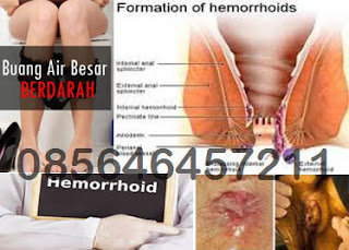 Harga Obat Wasir Bengkak di Apotik Herbal Online