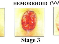 Pengobatan Ambeien Atau Wasir Luar