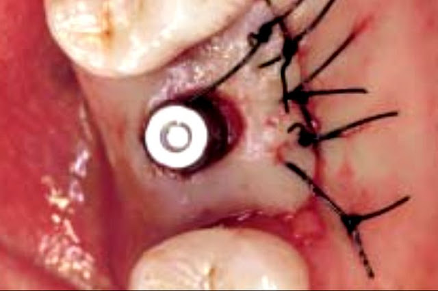 PDF: Immediate Loading of Single-Tooth Implants in the Posterior Region